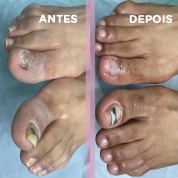 [Podologia - Limpeza Profilática Podal]
