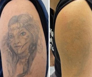 [Remoção de Tatuagem em Goiânia clareamento]